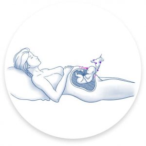 Cesarean illustration